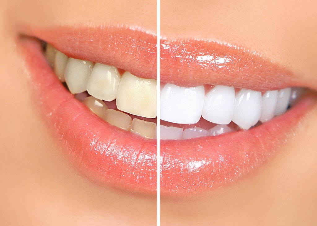Liquids to Avoid After Tooth Whitening