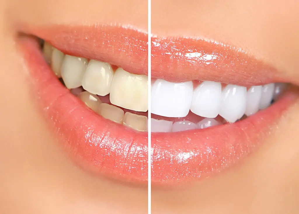 Liquids To Avoid After Tooth Whitening